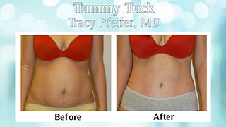 Tummy Tuck